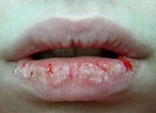 吃白色瓜嘴唇疼,白色瓜果引发嘴唇疼痛之谜探究